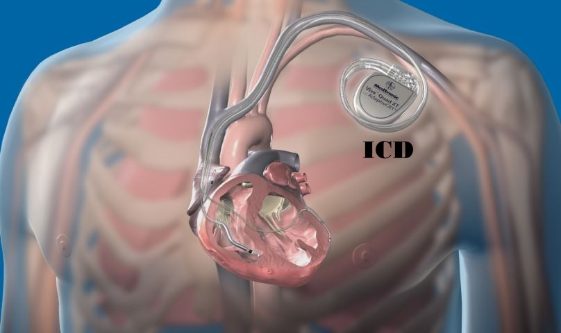 First cardioverter defibrillator implanted at Peebles Hospital