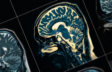 MRI of the patient's head close-up. One picture from the series.