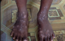 An infectious skin disease, similar to scabies, has emerged in Haiti. (CMC photo)