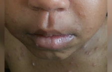 Be vigilant! 8 suspected cases of HFMD reported locally