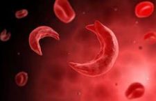 Everyone should get tested for sickle cell disease